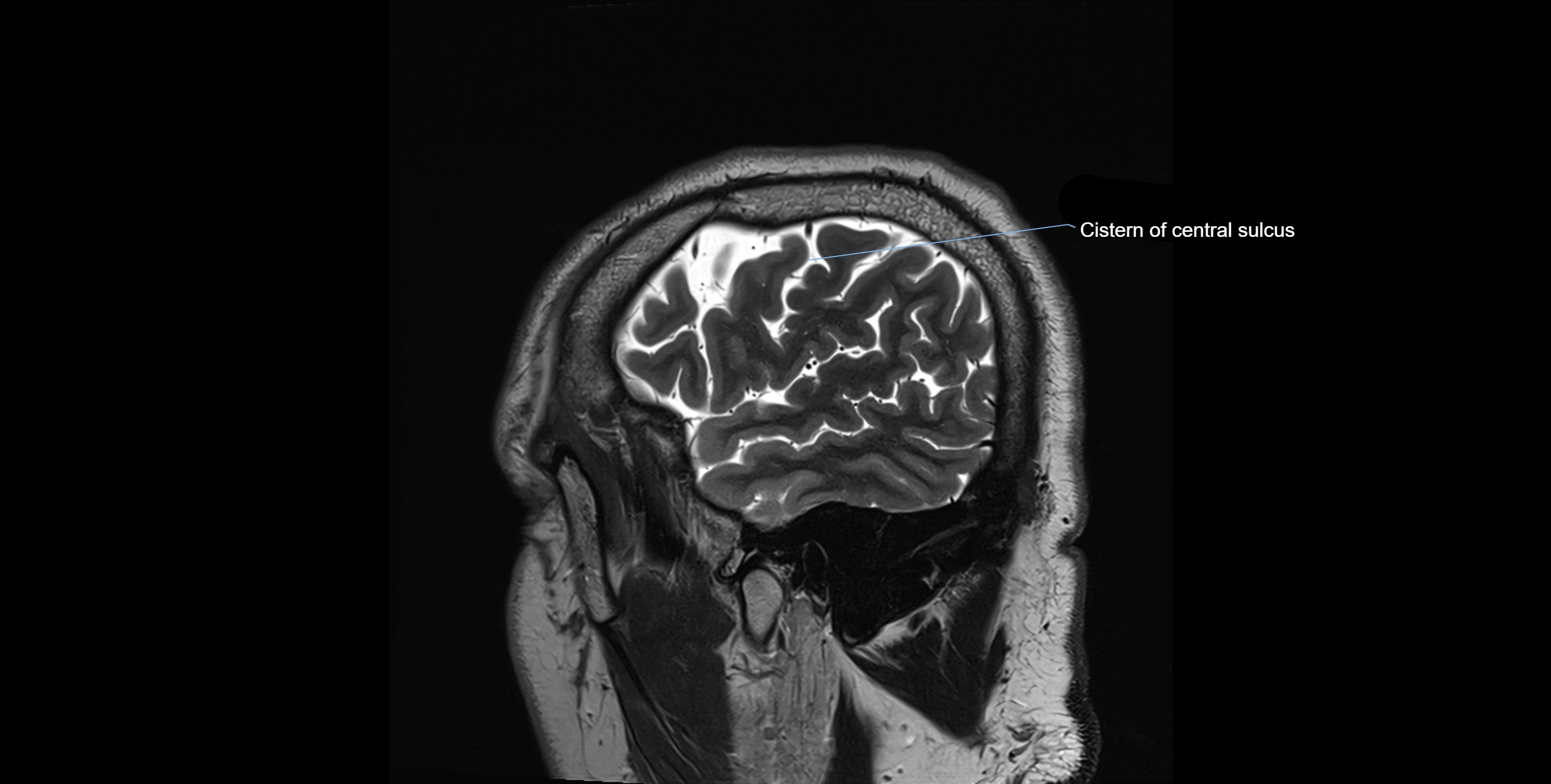Brain cisterns  and ventricles sagittal anatomy 3T MRI image-img-00001-00005.webp
